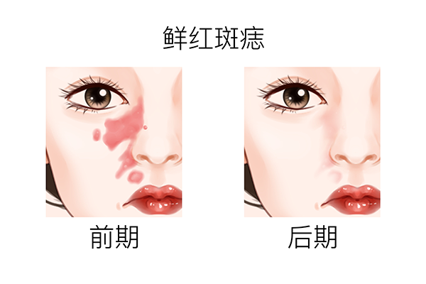 激光去痣后注意事项