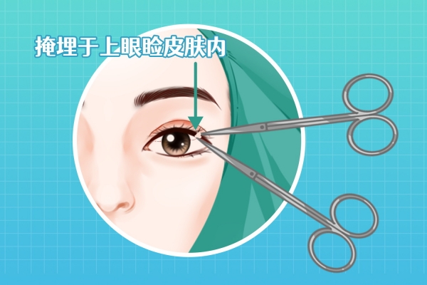 双眼皮太宽了怎么修复