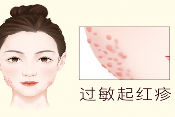秋季皮肤过敏怎么办