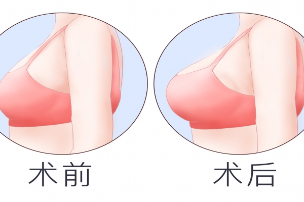 整形隆胸手术好不好